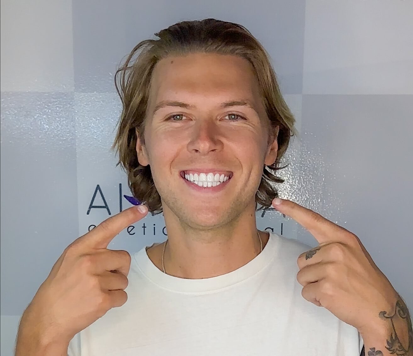 ¿Necesito carillas dentales? 6 señales para saberlo sin duda