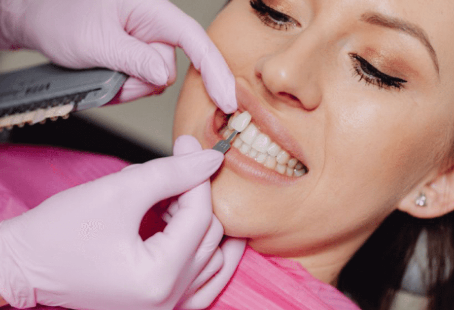 Carillas Dentales en México: Tu Destino para una Sonrisa de Ensueño
