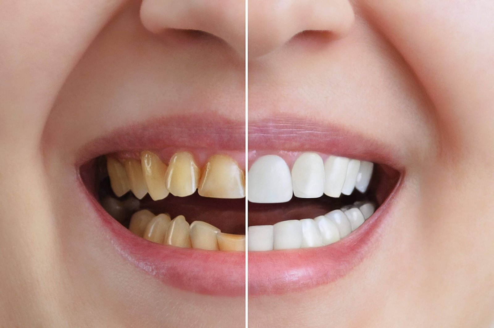 El Secreto de una Sonrisa Espectacular: Descubre los 5 Tratamientos Clave en Amatista